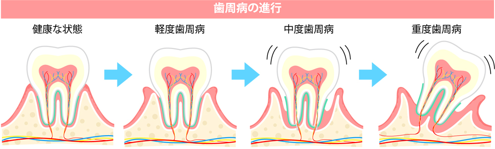 歯周病のメカニズム