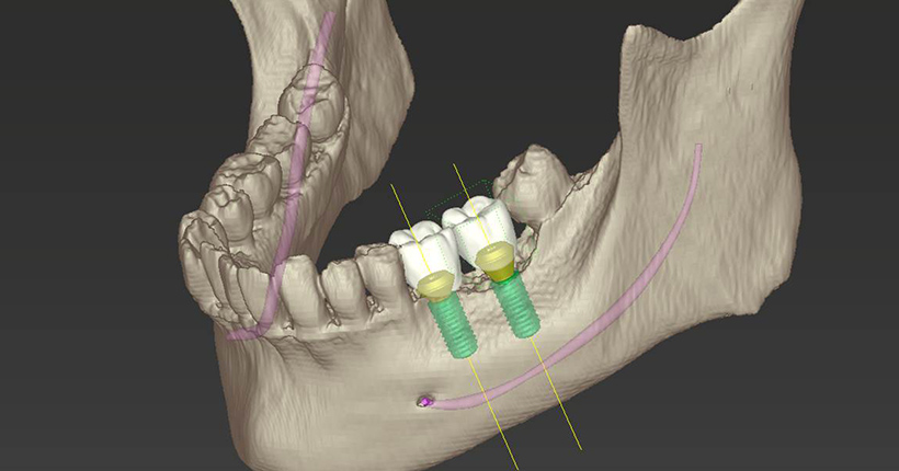 2.治療計画の立案