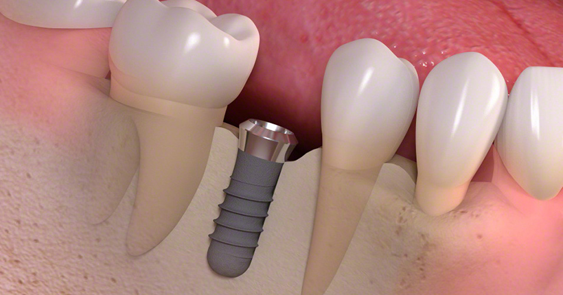 3.インプラント埋入手術