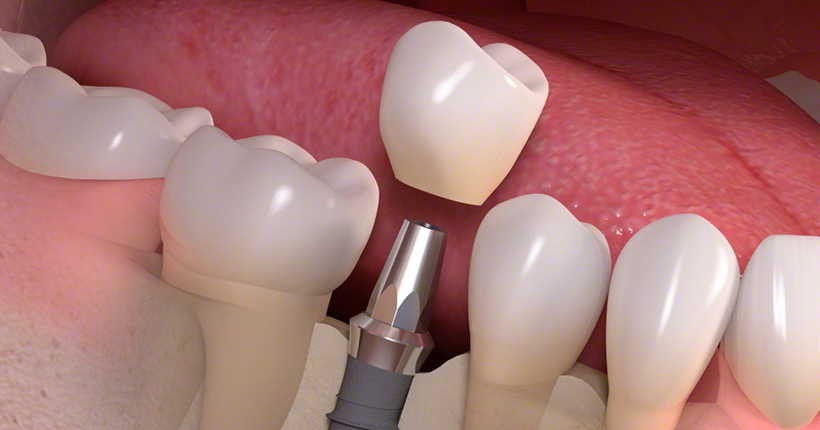 7.上部構造（セラミック製の人工歯）の装着