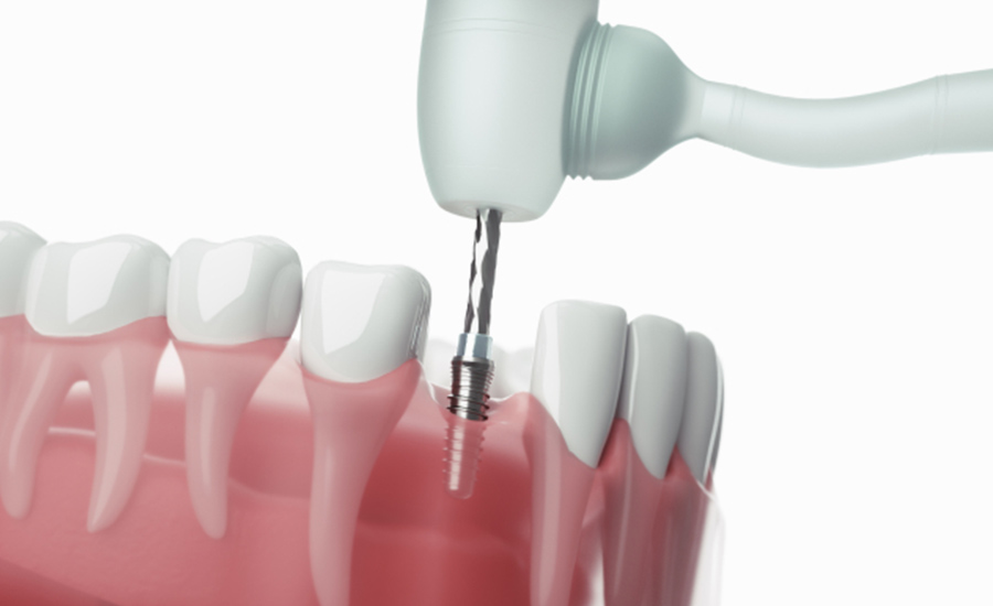 抜歯即時埋入（当日インプラント埋入）