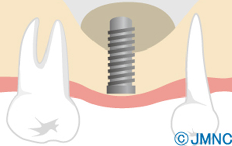 ソケットリフト
