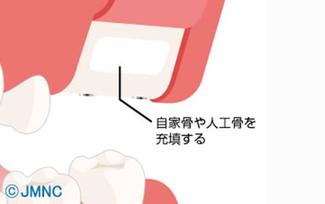 サイナスリフト