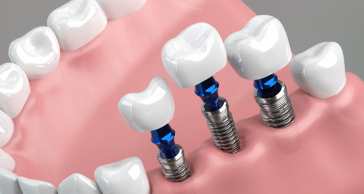 インプラント治療とは